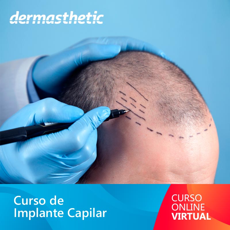Curso Online de Implante Capilar